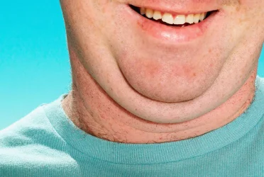 Say Goodbye to Your Double Chin: Effective Strategies for a More Defined Jawline