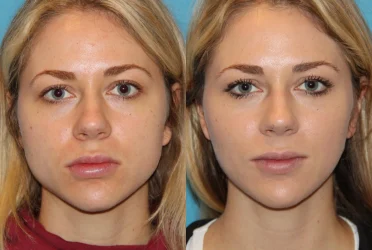 Enhance Your V Facial Shape with Jawline Botox: The Ultimate Guide