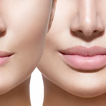 Understanding Lip Filler Indications: Your Complete Guide to Preparing and Aftercare