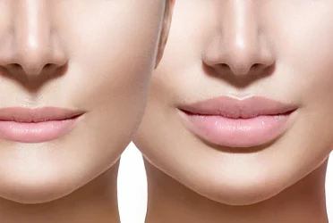 Understanding Lip Filler Indications: Your Complete Guide to Preparing and Aftercare