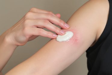 How to Treat Keloid Scars Safely and Effectively in Bali